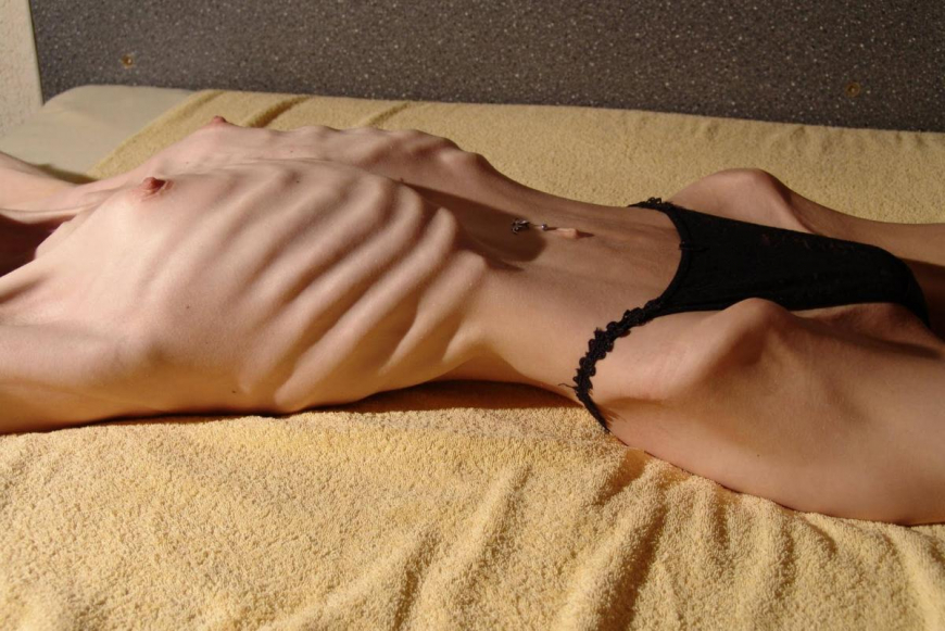 Анорексия голая красотка