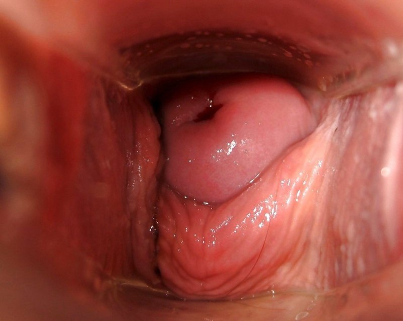 Вывернутое наружу влагалище