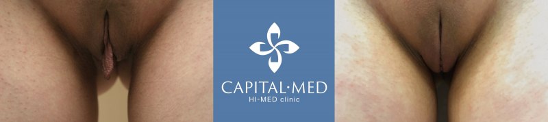 Лабиопластика пластика половых губ