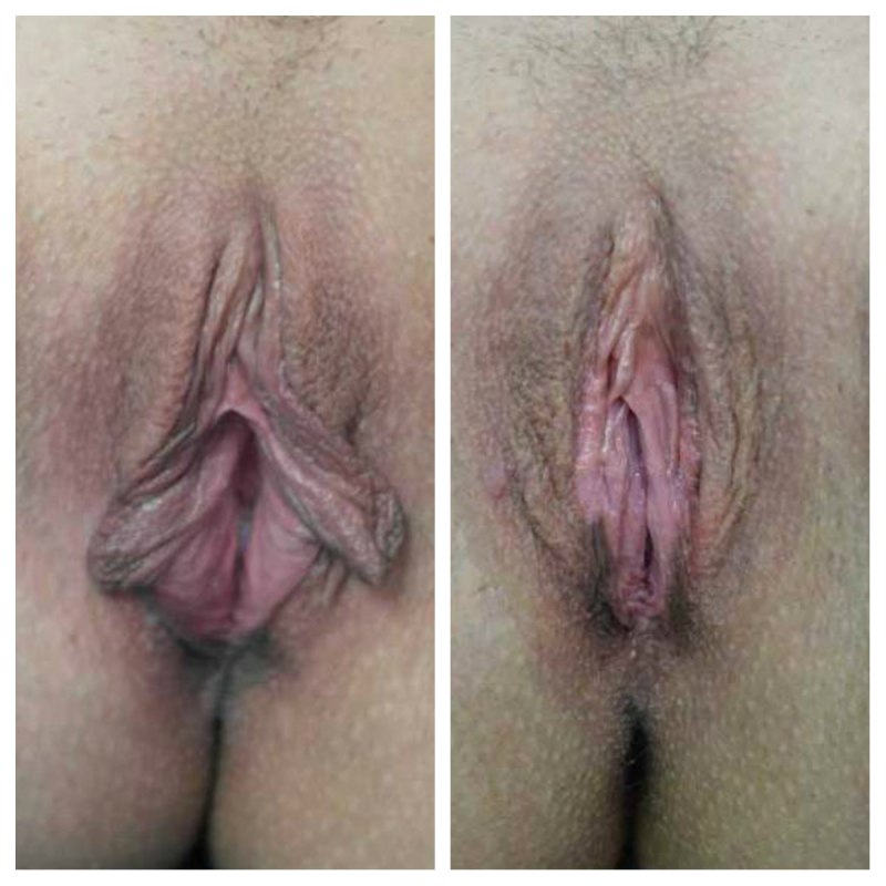 Интимная пластика половых губ до и после