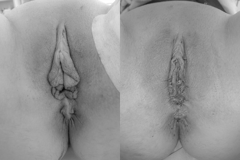 Вагина после лабиопластики