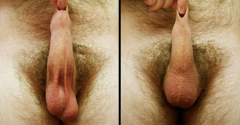 Мошонка здорового человека