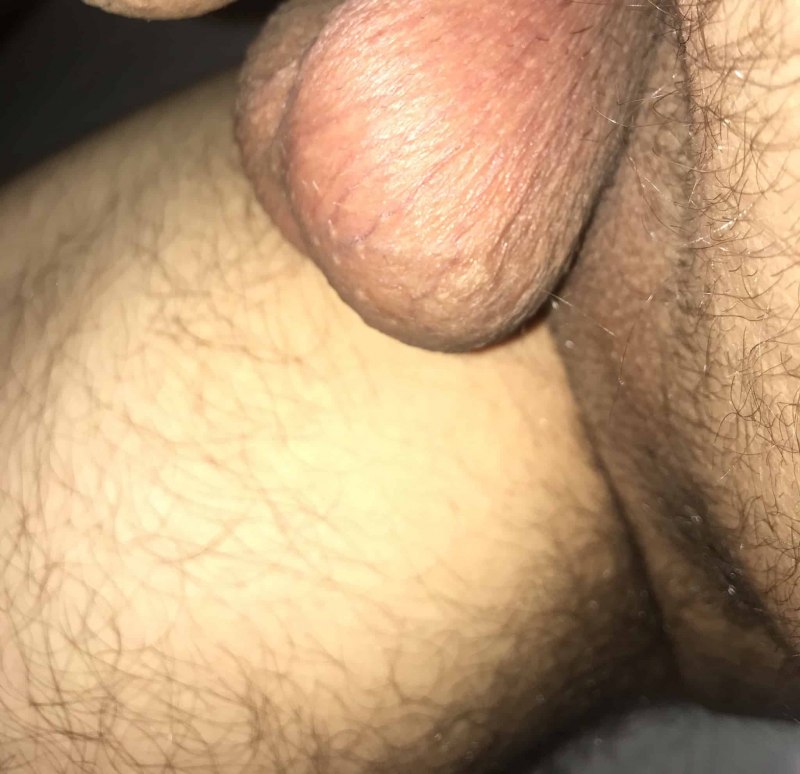 Потемнение вен на яичках